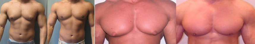 Comment faire fondre vos seins d'homme avec le gynectrol de crazybulk